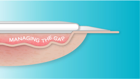 Come gestisci il gap fra il letto di lesione e la medicazione?