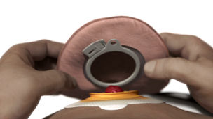 Sistema due pezzi per ileostomia con aggancio meccanico