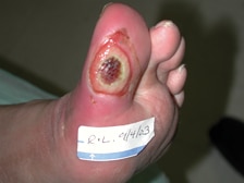 Ulcera del piede infetto