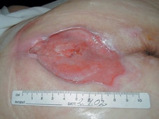 L'ulcera dopo quattro settimane di trattamento.