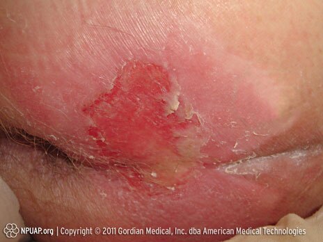 Categoria/Stadio II dell'ulcera da pressione: Perdita di spessore parziale del derma o vescica 