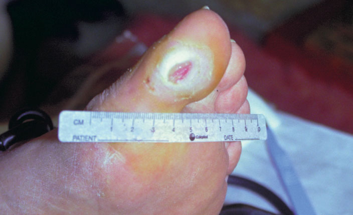 ulcera del piede neuropatico