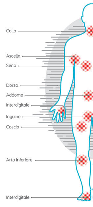 Danno associato alle pliche cutanee