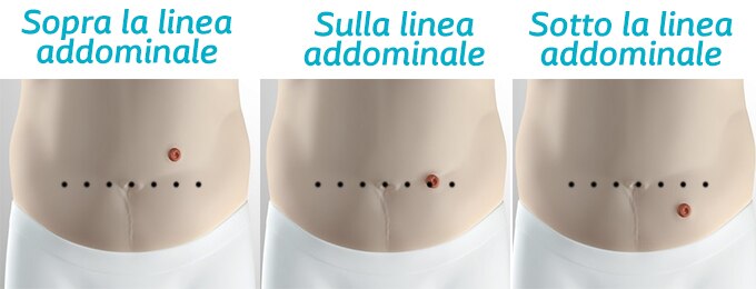 Posizione stoma rispetto la piega addominale