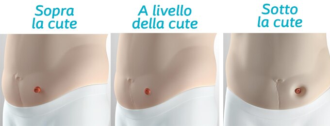 Posizione stomia