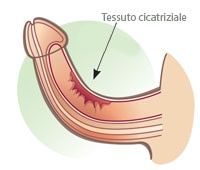 rimozione tessuto cicatriziale pene