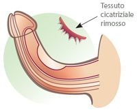 rimozione tessuto cicatriziale pene