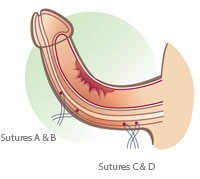 chirurgia pene