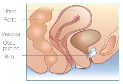 sling system