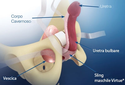 chirurgia sling maschile