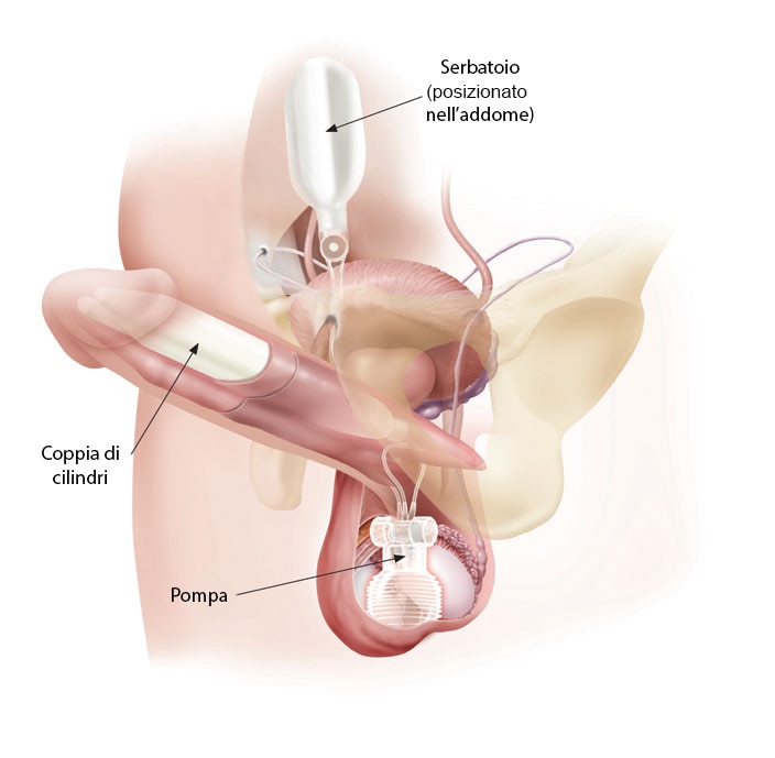 Titan penile implant